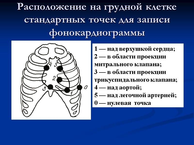 Расположение на грудной клетке стандартных точек для записи фонокардиограммы 1 — над верхушкой сердца;
